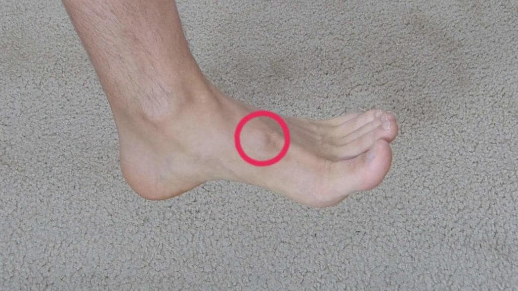 bump on top of foot