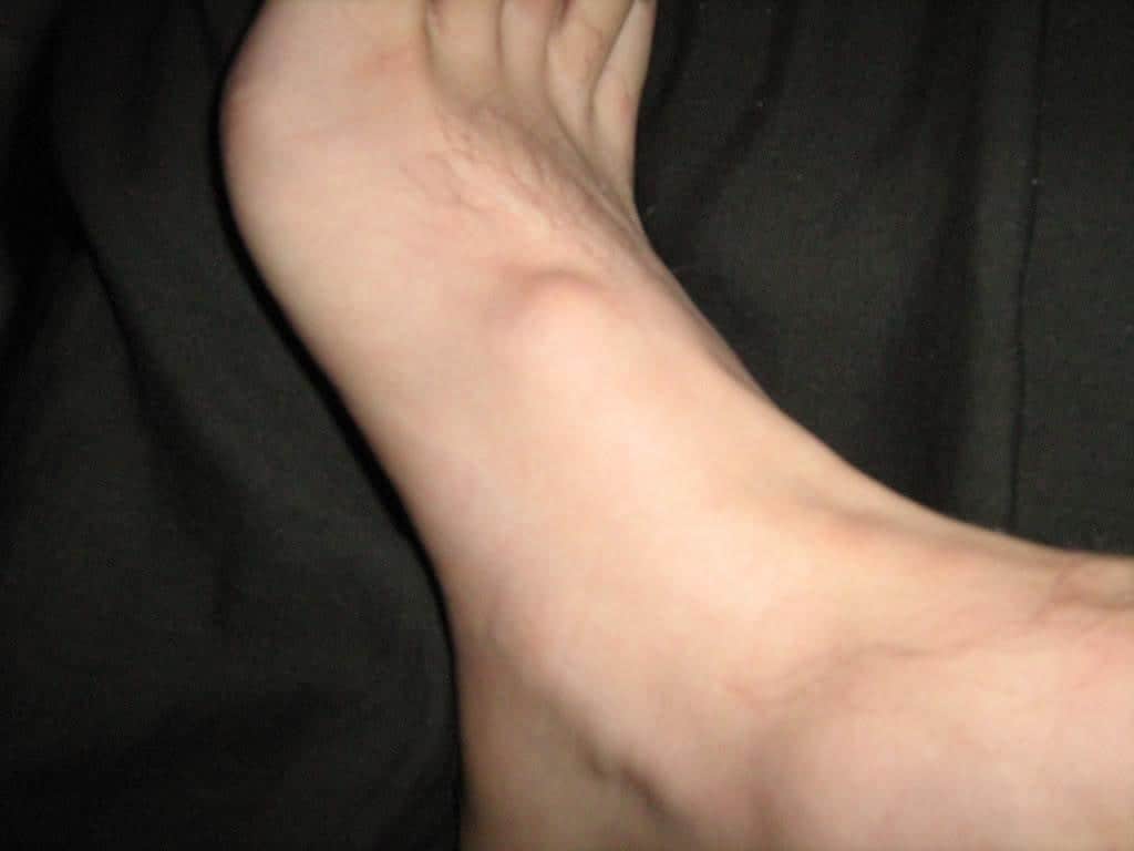 foot bump due to Ganglion Cysts