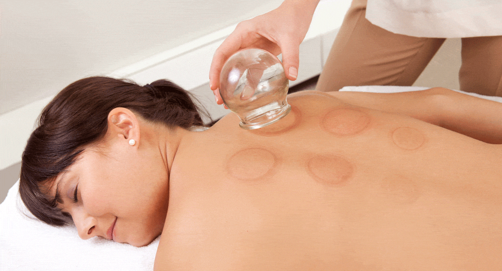 cupping therapy